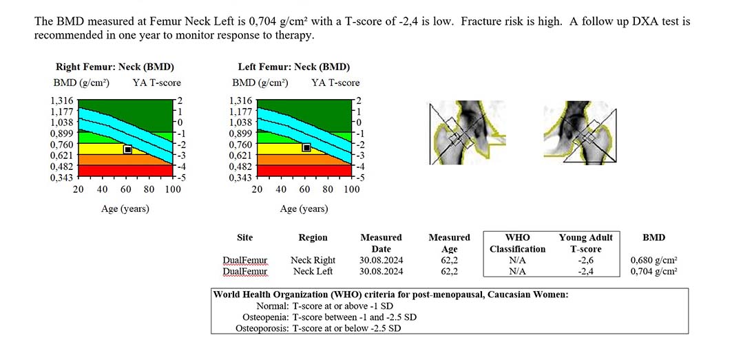 Денситометрия